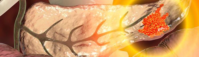 Устройство от Novocure увеличивает выживаемость при раке поджелудочной железы