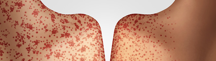 С 2025 года от кори умерли по меньшей мере 28 жителей Мексики С 2025 года от кори умерли по меньшей мере 28 жителей Мексики