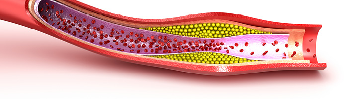 MSD: достигнута основная цель исследования препарата для снижения холестерина MSD: достигнута основная цель исследования препарата для снижения холестерина