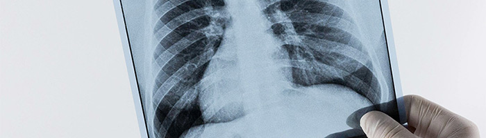 Сгенерированные рентгенограммы неотличимы от настоящих даже для специалистов Сгенерированные рентгенограммы неотличимы от настоящих даже для специалистов