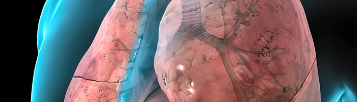 Тозоракимаб от AstraZeneca уменьшил частоту обострений у пациентов с ХОБЛ Тозоракимаб от AstraZeneca уменьшил частоту обострений у пациентов с ХОБЛ