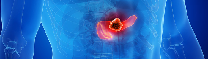 Дараксонразиб от Revolution повышает выживаемость при раке поджелудочной железы